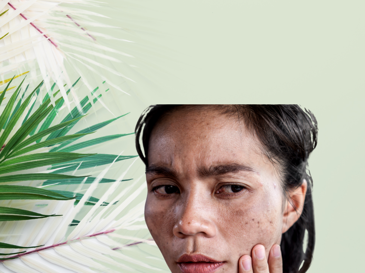 Taches Pigmentaires / Hyperpigmentation